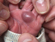 Een pasgeborene met een zwelling op de hand