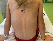 Een meisje met gedempte percussie en opgeheven ademgeruis over de linkerthorax