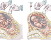 Hemolytische ziekte van de foetus en pasgeborene