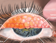 Keratoconjunctivitis vernalis