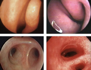 Allergische rinoconjunctivitis