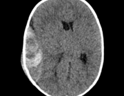 Een afwijkende CT-scan bij een kind met traumatisch hoofdletsel